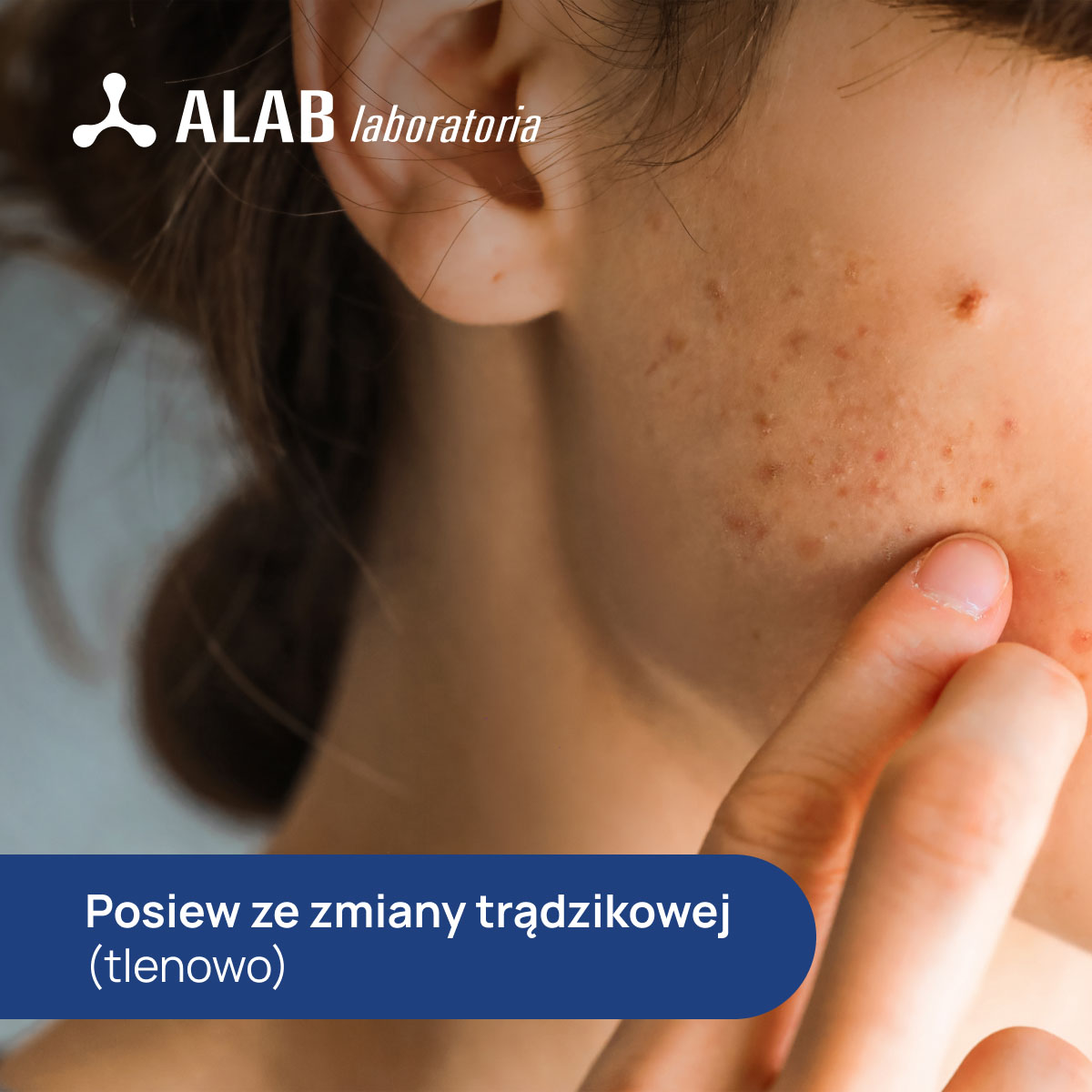 Posiew ze zmiany trądzikowej (tlenowo)